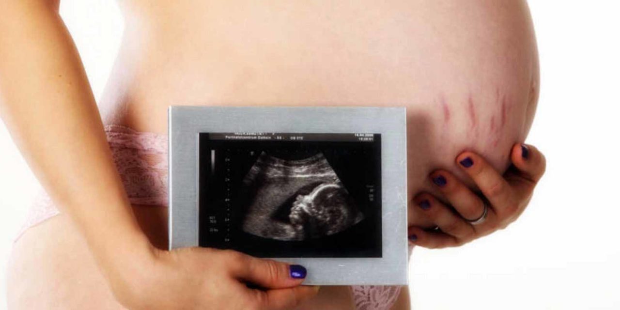 Schwangerschaftsstreifen verhindern & los werden