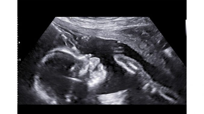 Ultraschaill Bild eines Kopf in der 14. SSW